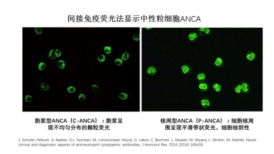通过间接免疫荧光法检测区分c-anca与p-anca,利用酶联免疫吸附试验