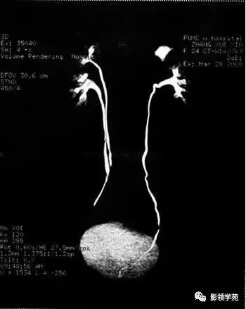 双侧双肾盂双输尿管畸形