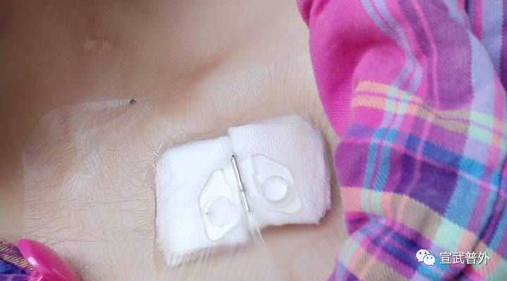 植入式静脉输液港请和我一起学习