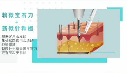 3d植发技术是通过使用专利精密仪进行提取,然后经过高精显微仪进行