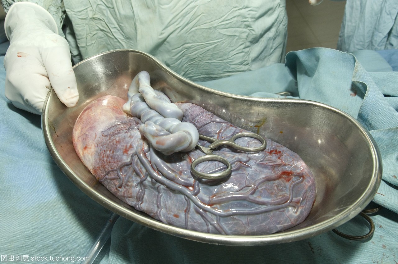 剖腹产就是血淋淋的画面?看完这5张图就知道