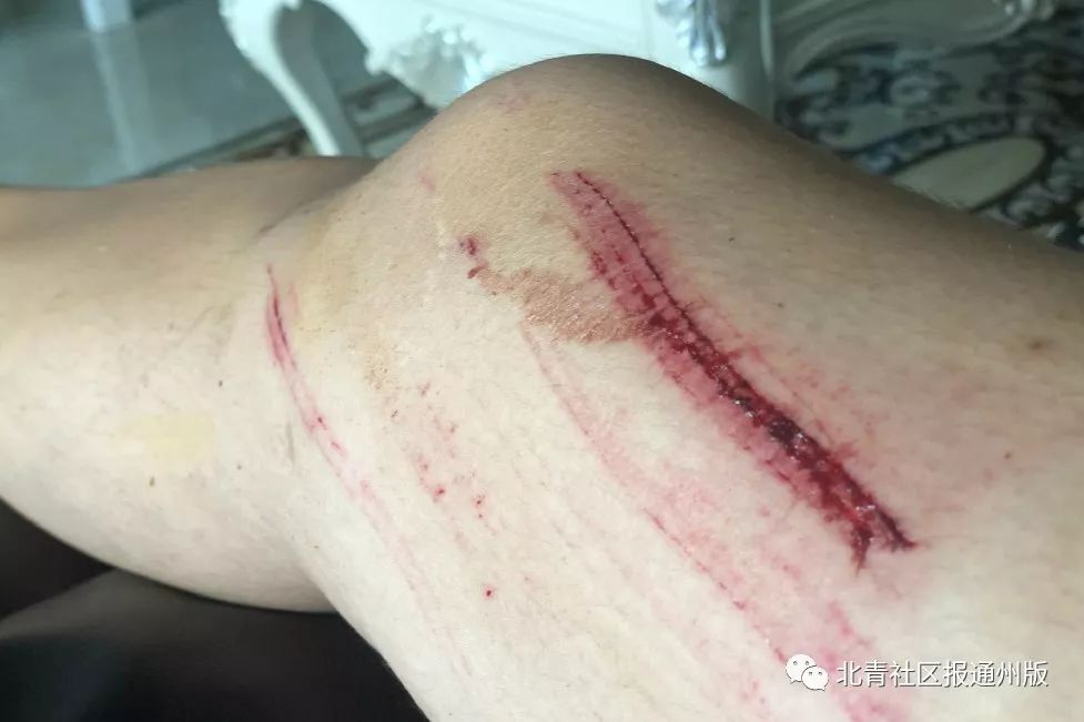 看着就疼!通州一公园木板路"咬伤"行人大腿,事发地拉起警戒线