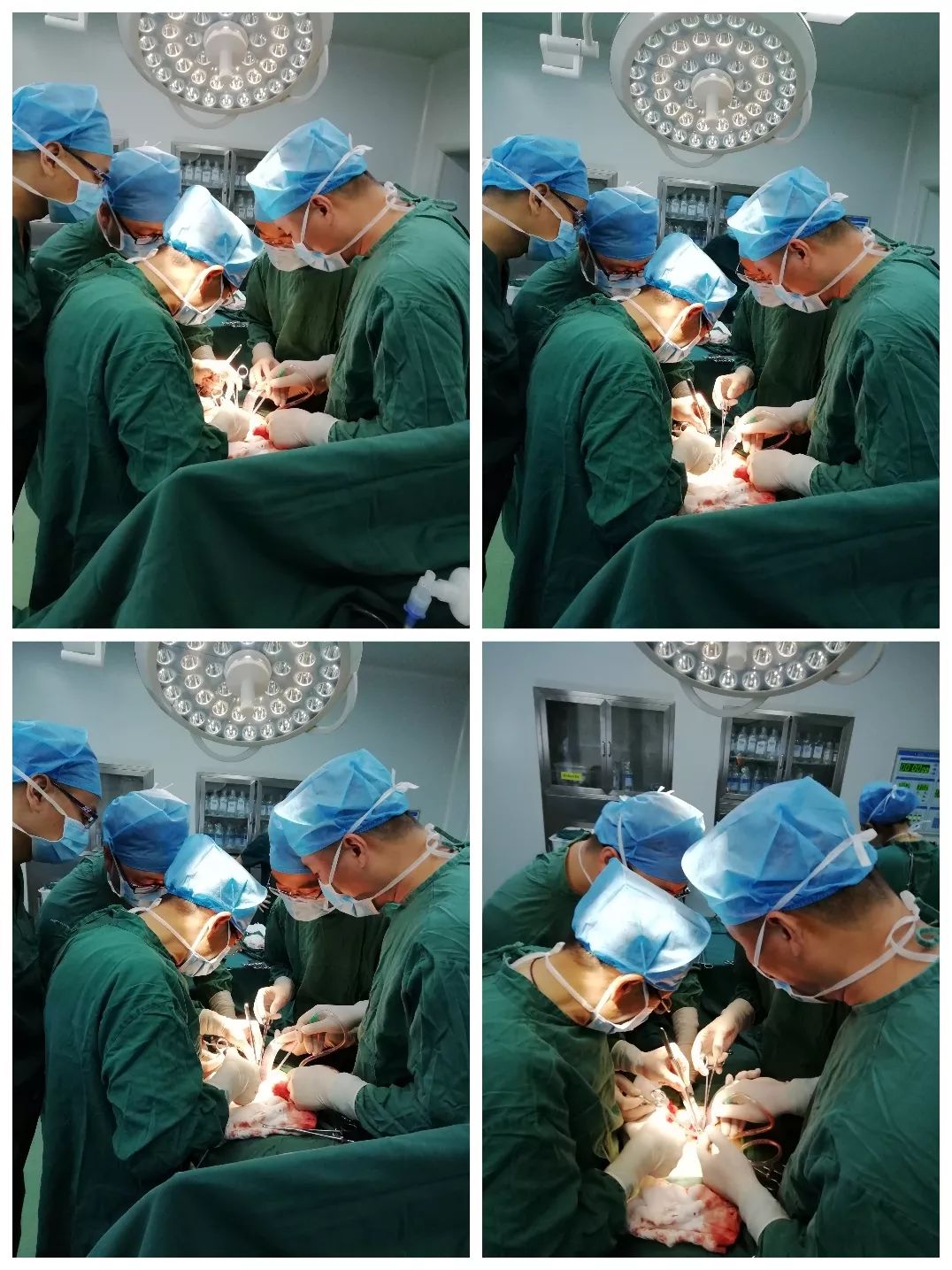 在我市泌尿外科主任委员卢学仁指导下手术,术中选左侧侧腹膜入路,优势