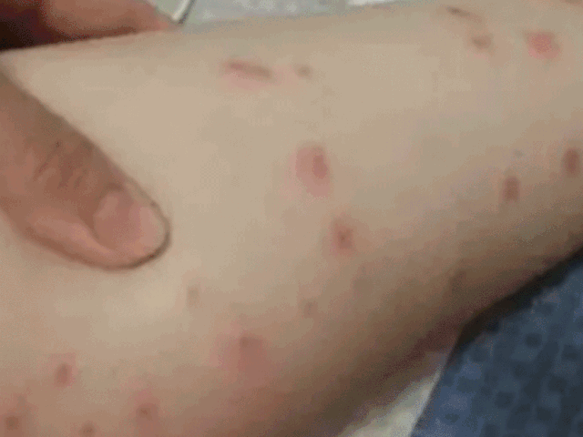 小心这种飞虫比蚊子还毒被咬后奇痒无比三四天消不掉