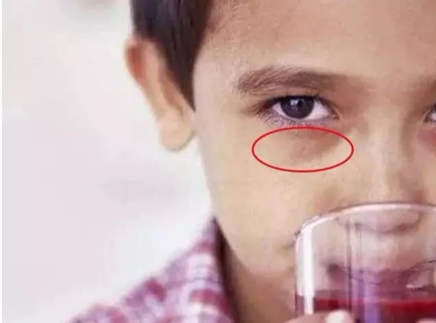 哪吒虽萌,但如果你家孩子有哪吒同款黑眼圈?可能是疾病
