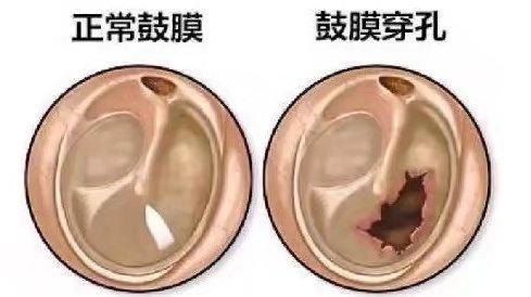鼓膜穿孔对耳朵有影响吗凤阳府北街助听器