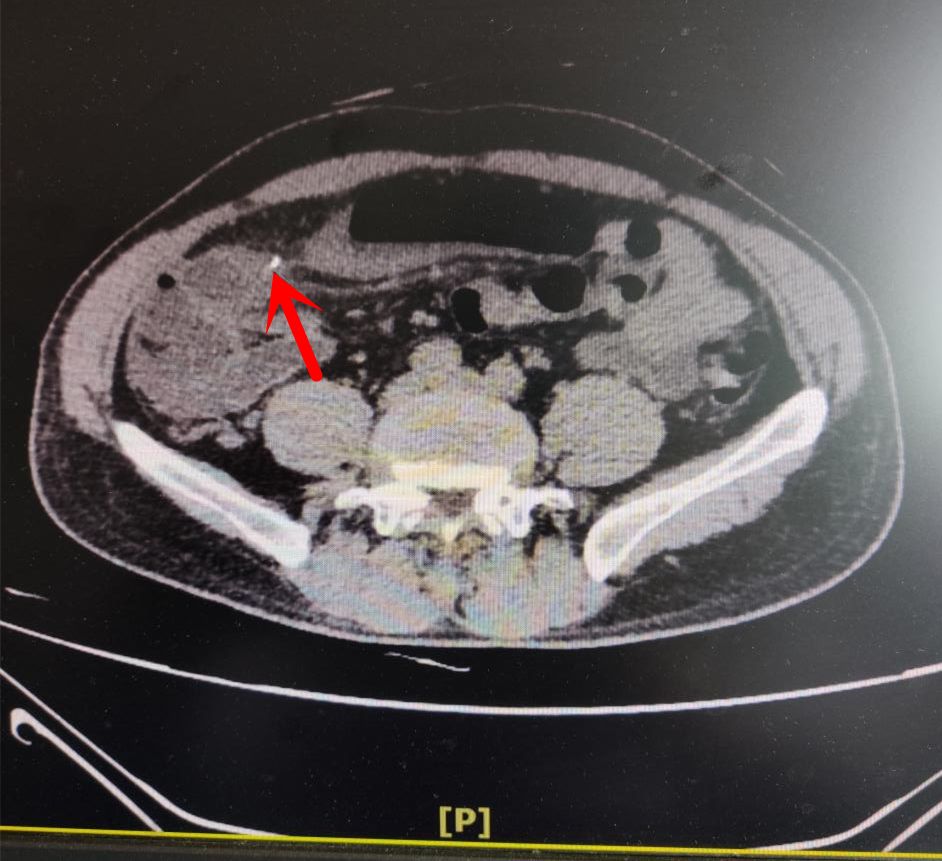 为啥医生总让您完善检查吃鱼3天后3cm鱼刺让他肠穿孔