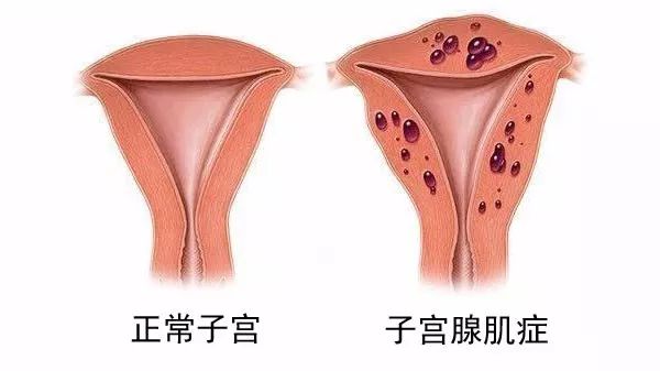 子宫腺肌瘤癌变前期图片