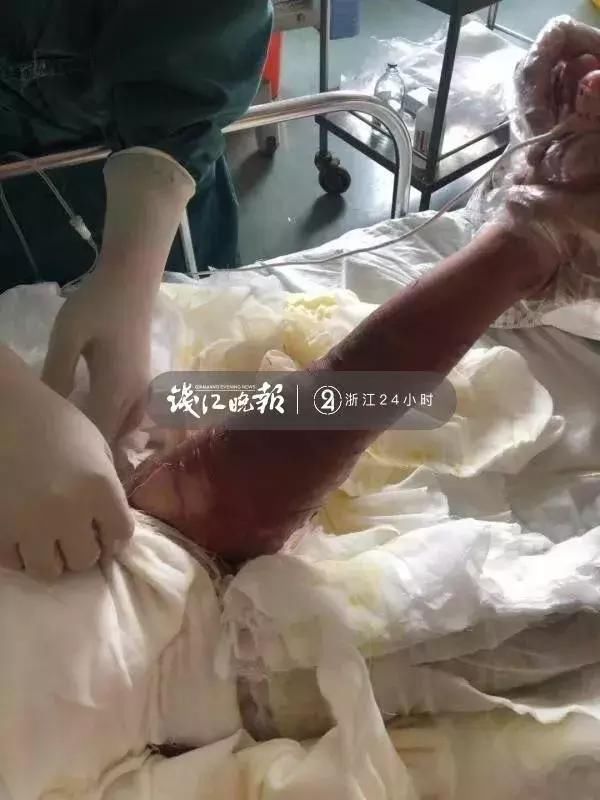 醫生全力救治孩子轉危為安 台州醫院燒傷科主治醫師王史輝在孩子送到