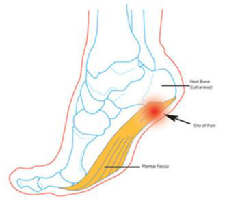 跖筋膜炎的症状图图片