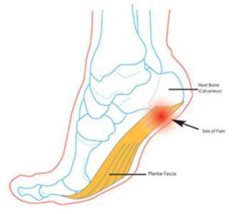 原创史上最全足跟痛足底筋膜炎的诊断与治疗要点