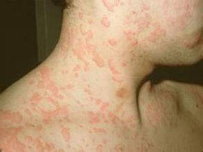 夏季皮肤病湿疹荨麻疹皮炎反复折磨如何正确治疗