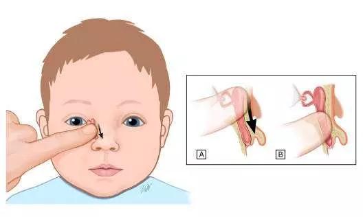 7個月嬰兒眼睛淚汪汪原來是淚道堵塞惹的禍