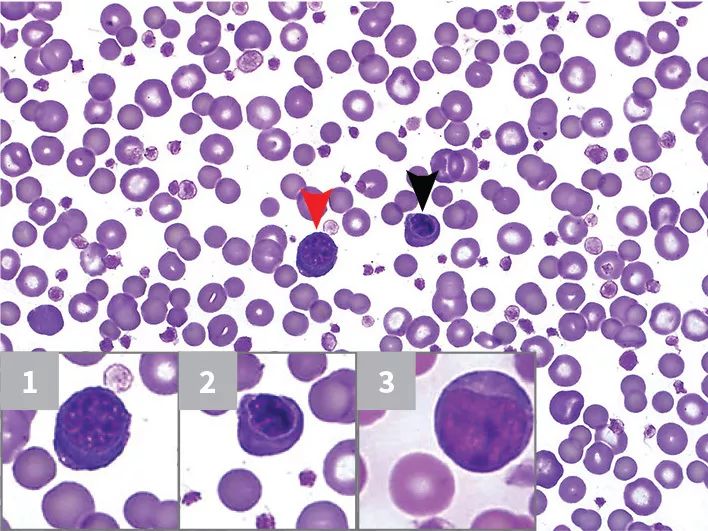 5張血塗片快速瞭解白細胞象和肥大細胞血癥,快來看分析!_粒細胞