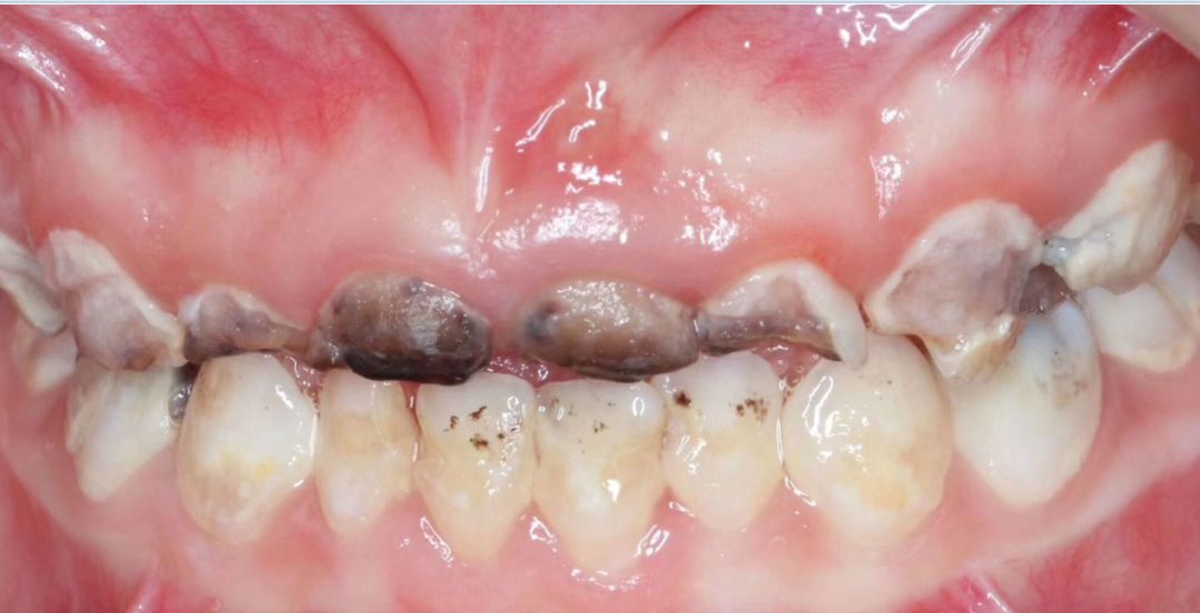 吃夜奶牙齿被腐蚀图片