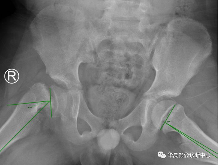 股骨干骺端图片图片