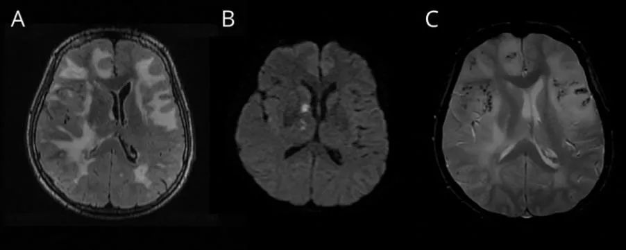 期刊精华丨neurology6月刊青年人卒中炎性脑血管淀粉样变