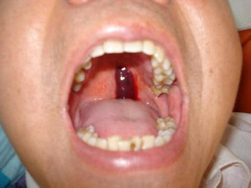 一,症状表现1,口腔毛细血管瘤:由许多增生的毛细血管组成,常发生唇红