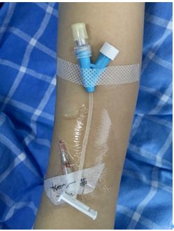 留置针穿刺回血好为什么不一定成功