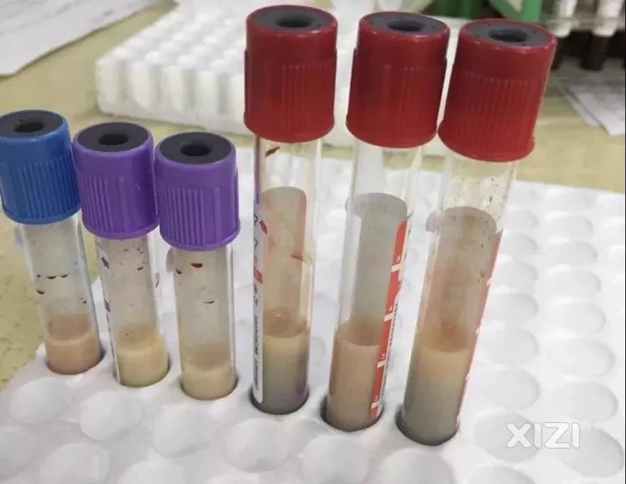 惠州一胖小伙化验时抽出牛奶血血为奶白色
