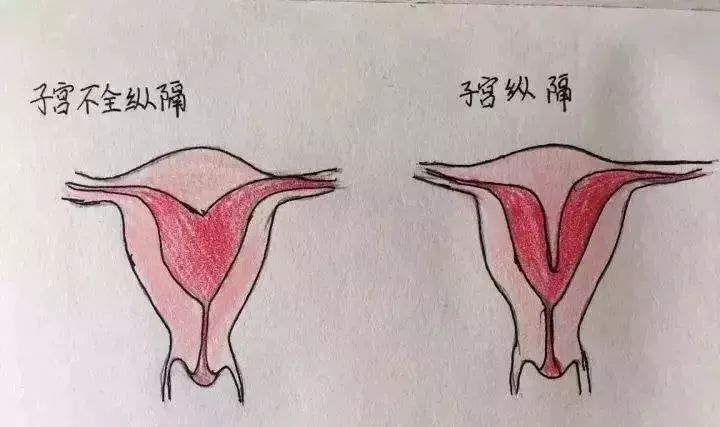 檢查出子宮縱膈還能順利懷孕生孩子嗎