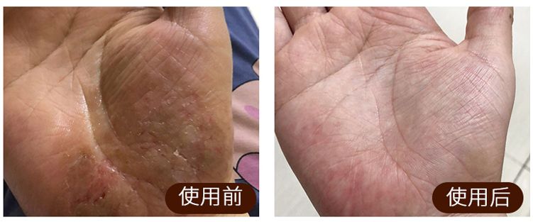 皮炎湿疹足癣轮番上用它抹一抹几块钱就能好