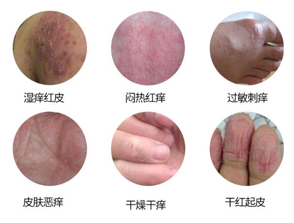 皮炎湿疹足癣轮番上用它抹一抹几块钱就能好