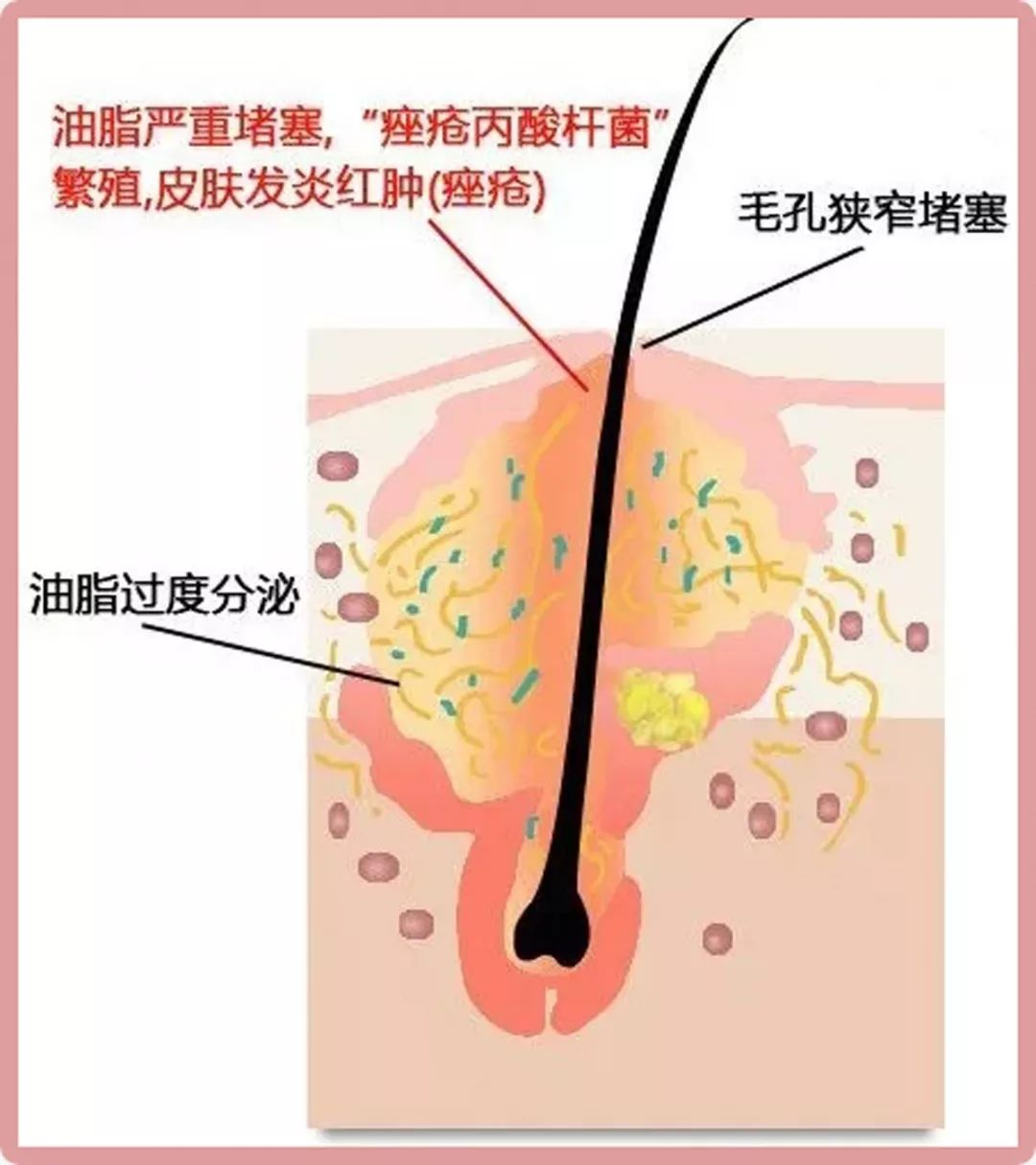 大家都知道,痘痘的元兇其實是痤瘡丙酸桿菌,它是一種厭氧菌,最喜歡