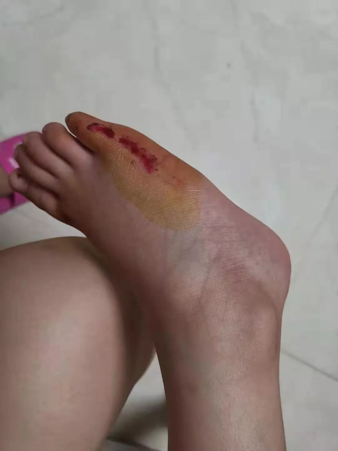 女孩子脚摔伤图片