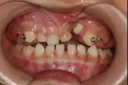 地包天矫正要趁早最佳治疗时间是什么