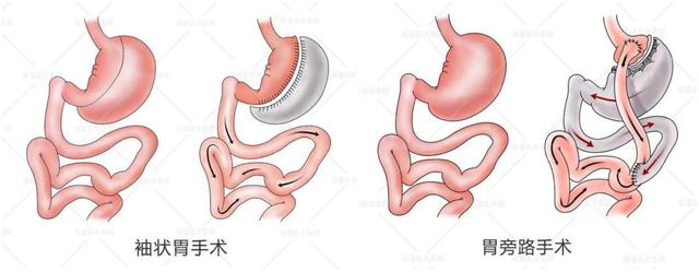 袖状胃空肠旷置手术图片