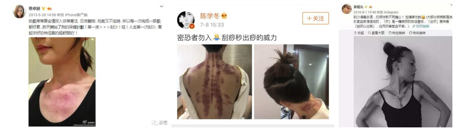 刮痧，到底刮的是什么？_治疗