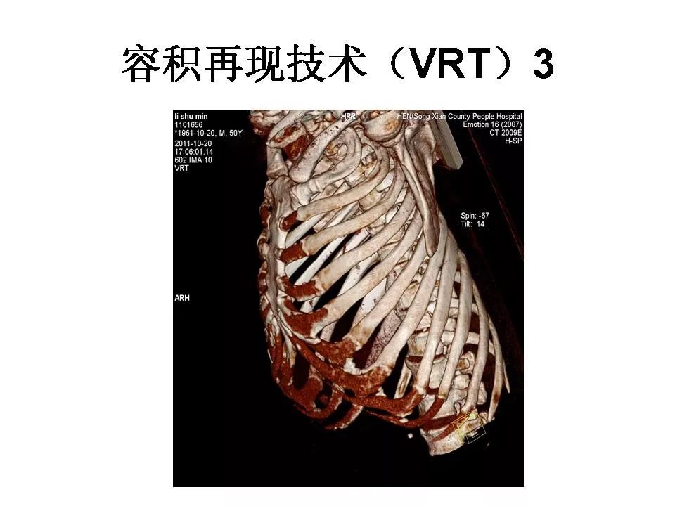 三维重建技术在肋骨骨折中的应用 