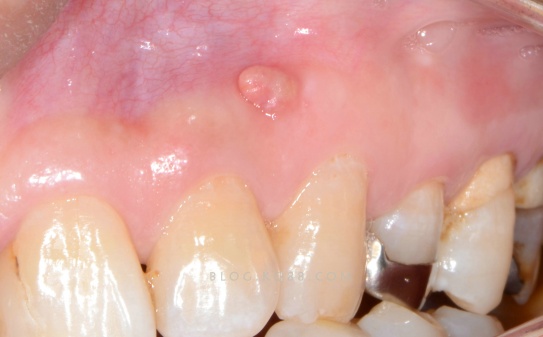 炎症而引发的那些渗出液,脓液就会慢慢的穿破牙齿外侧的骨壁形成瘘道