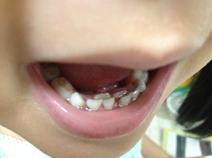 5岁半换牙正常吗图片