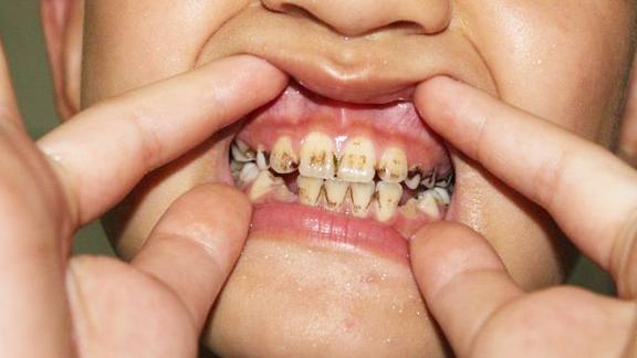 长期抽烟牙齿又黄又臭怎么办学会这招不花钱洗牙就能让牙变白