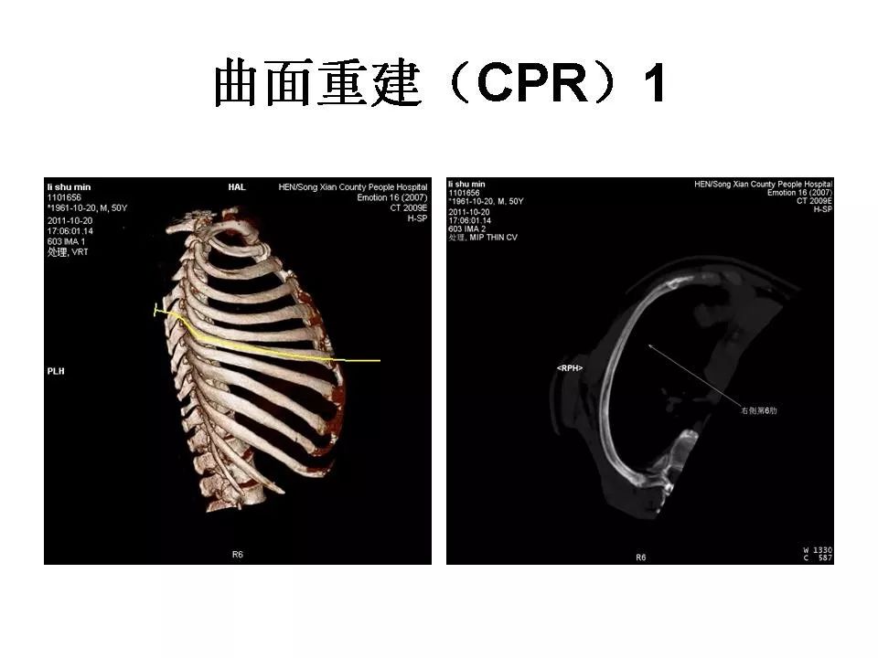 三维重建技术在肋骨骨折中的应用 