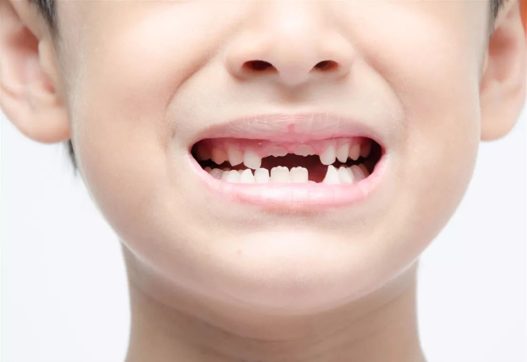 营养不良导致先天性个别牙齿脱落,或者上下牙齿咬合面不平,也是导致