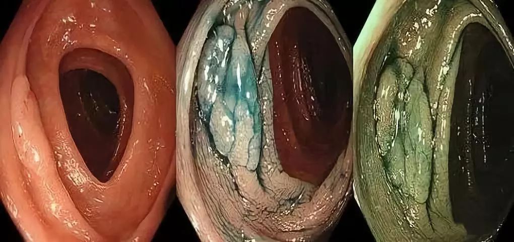 只有规范的肠镜检查才能提高早期肠癌的检出率