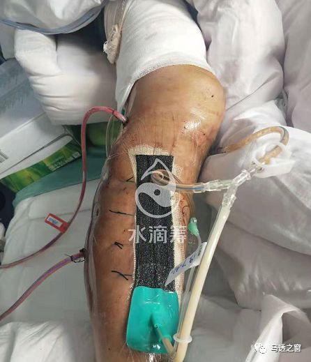 连江一老人不幸遭遇车祸大腿断裂腿部多处肌肉开裂伤势严重现急需您的