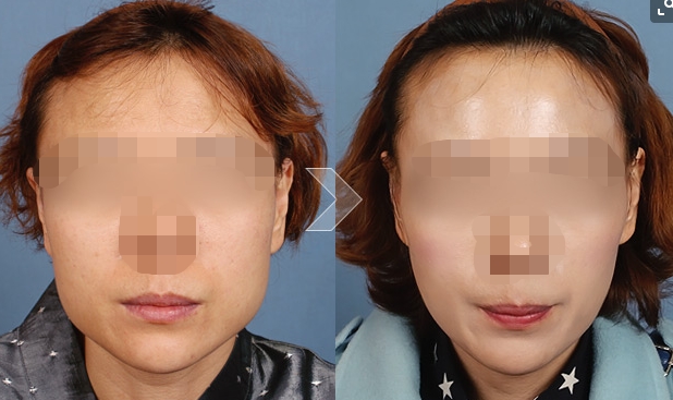 传说的瘦脸削骨颧骨磨骨术竟如此坑面部整形后遗症害人