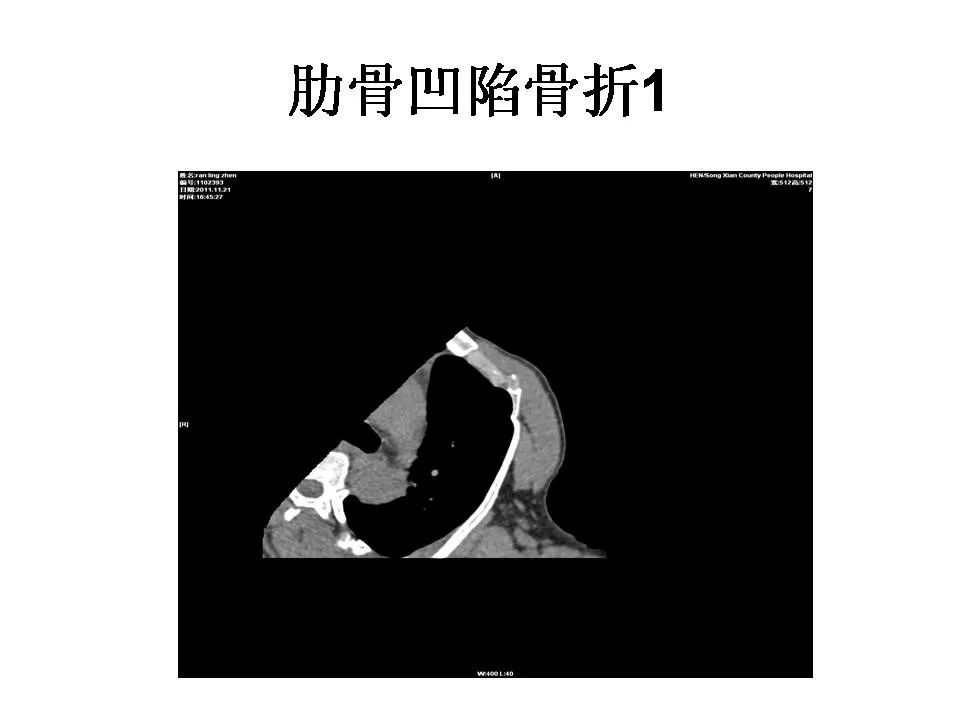 三维重建技术在肋骨骨折中的应用 