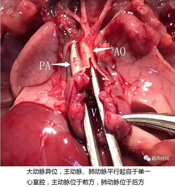 胎儿两腔心畸形看似容易其实很难