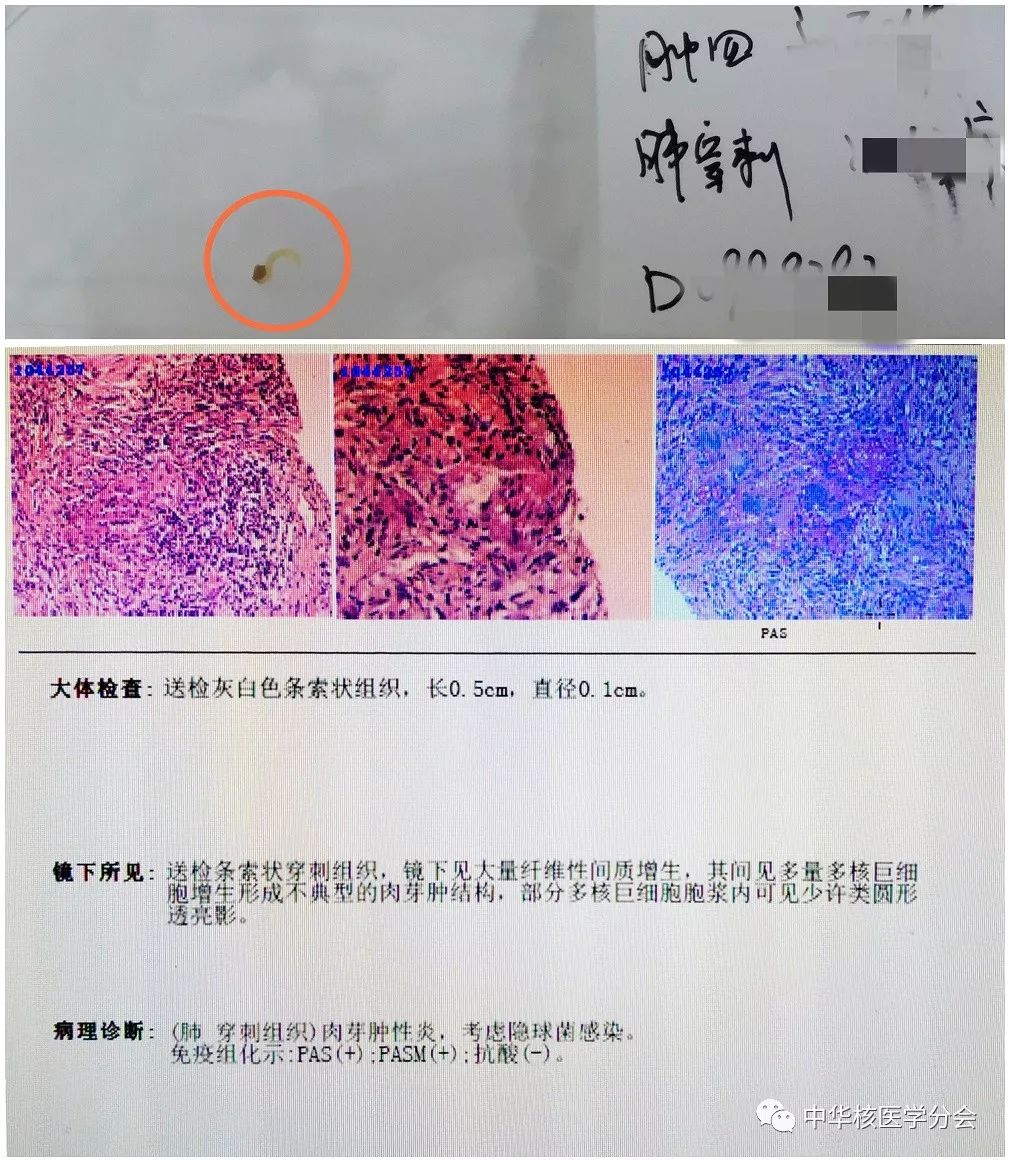 【临床】核医学spect/ct引导下肺微小结节穿刺活检术