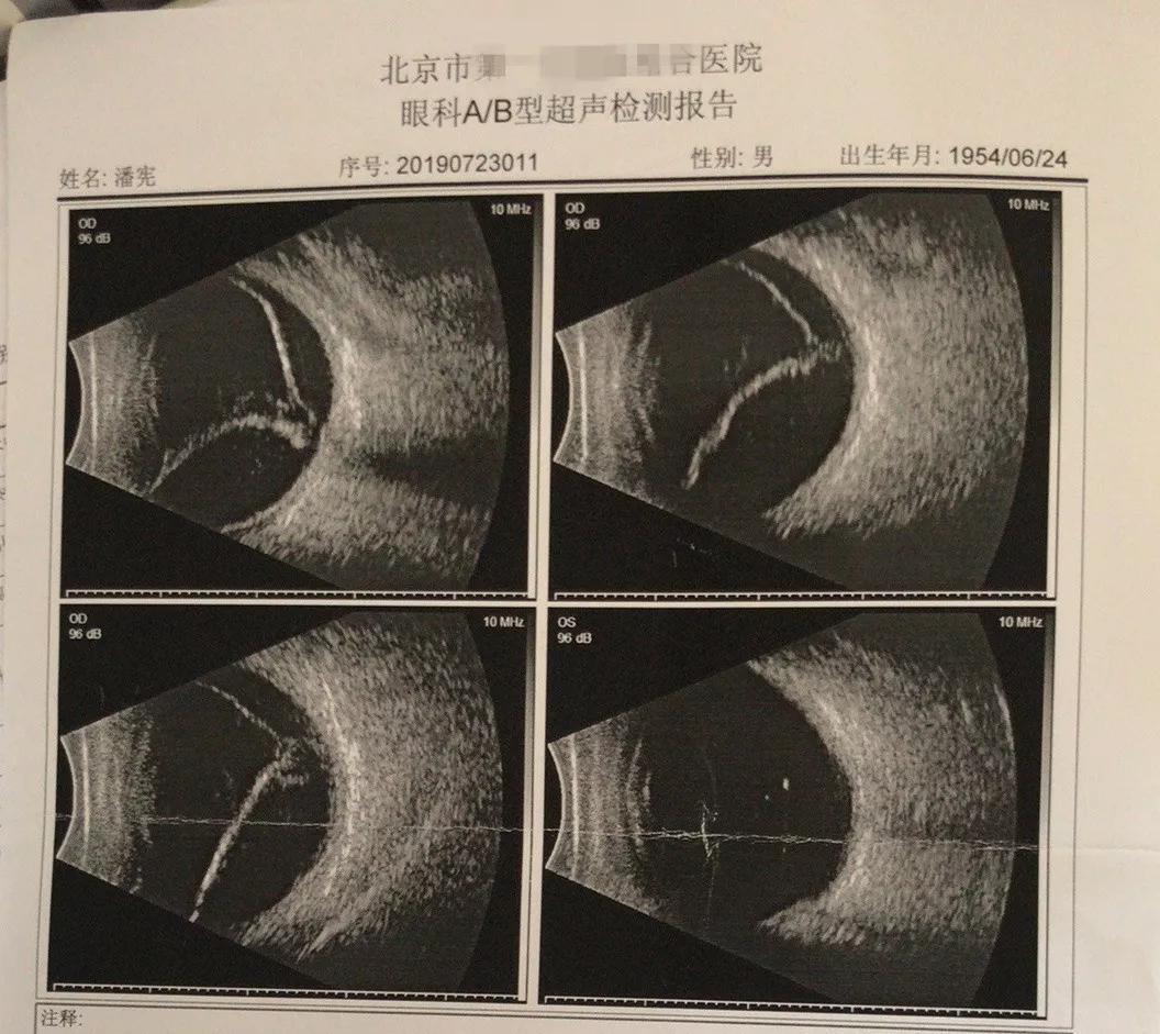 半年前右眼突然视物不见,曾就诊于北京某医院,诊断为"右眼玻璃体积血"