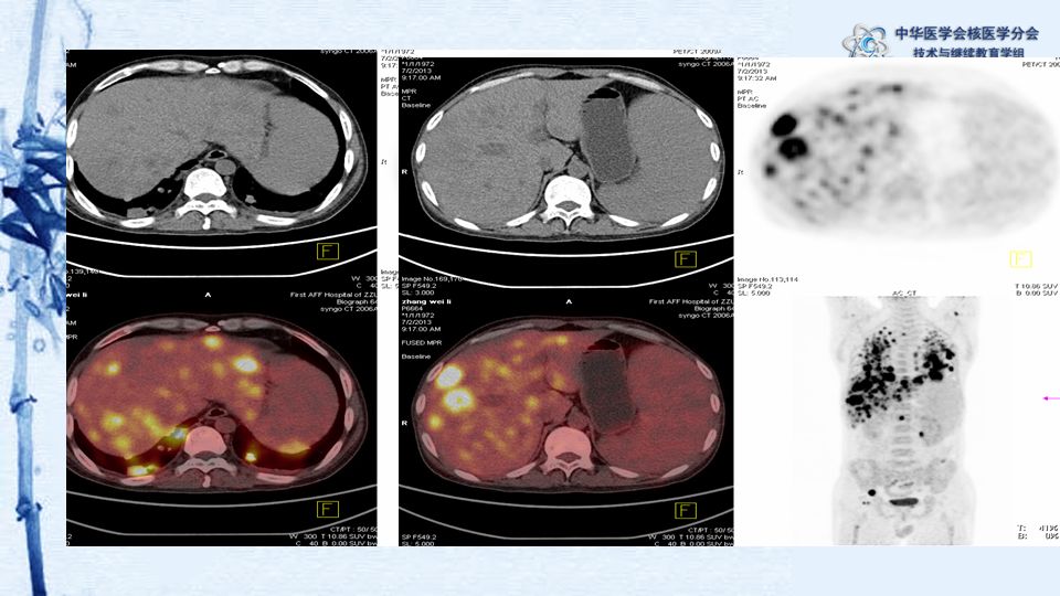 【病例】49期:程兵 | pet/ct显像诊断淋巴瘤相关噬血细胞综合征一例