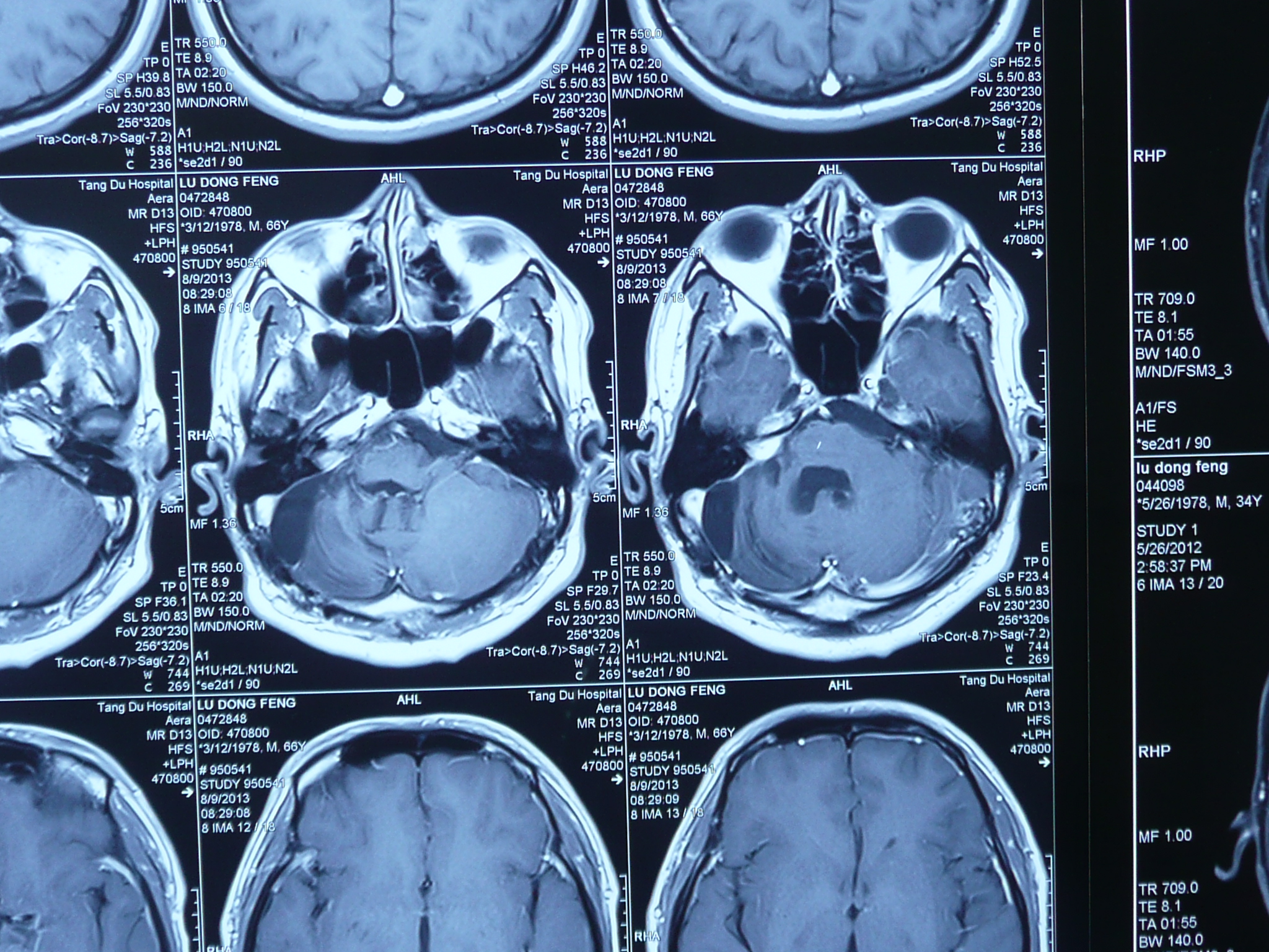 脑桥小脑角恶性肿瘤图片