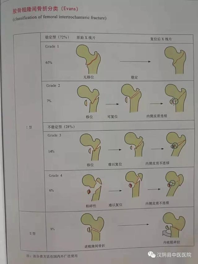 压疮股骨粗隆位置图图片