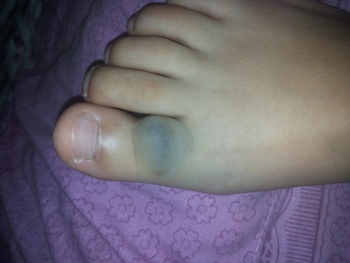 血管瘤是怎么回事听听专家怎么说