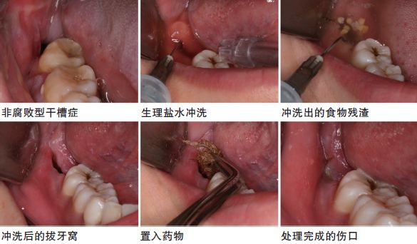 干槽症能自愈吗图片